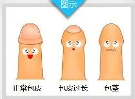 包皮包茎手术多少钱呢？