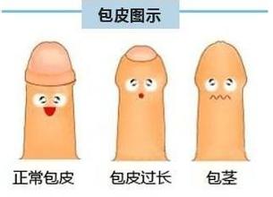 河池包皮过长可导致阴茎癌的出现?