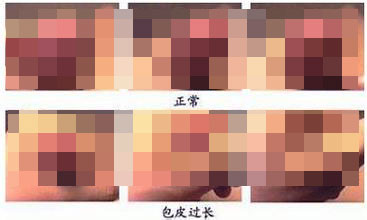 怎么样算是包皮过长?