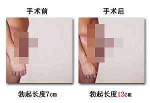 河池做阴茎延长医院哪家好呢？