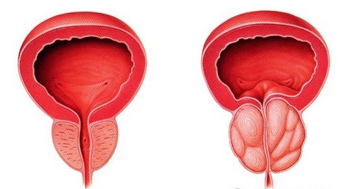 河池男性为什么会患上前列腺肥大